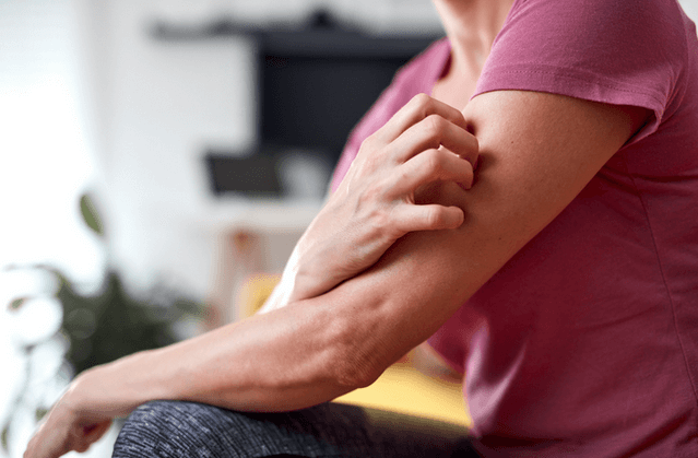 Woman scratching her arms